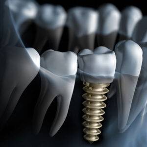 Implantology