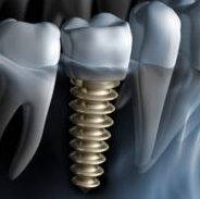 Implantology